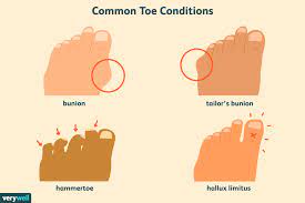 Check spelling or type a new query. Overview Of Tailor S Bunion