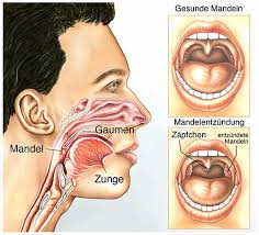 «wenn jemand ständig eitrige infekte hat, die mit fieber und schmerzen einhergehen, ist eine tonsillektomie dringend ansonsten zählt die entzündungsfrequenz: Was Ist Mandelentzundung Tonsillitis Ursachen Symptome Behandlung Krank De