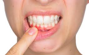 If you're on the lookout for foods that can help lower your risk. Healthy Gums Healthy You Lifetime Dental Group Canton South Lyon Michigan Lifetime Dental Group Canton South Lyon Michigan