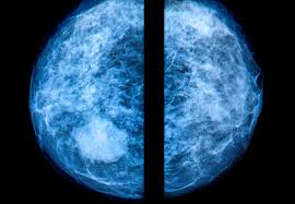 What does a tumor look like on an x ray. Dense Breast Tissue How 3d Mammograms Other Tests Help Find Hidden Cancers Health Essentials From Cleveland Clinic