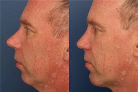 Rhinoplasty Before and After Photos by Ronald Schuster, MD; Lutherville, MD 