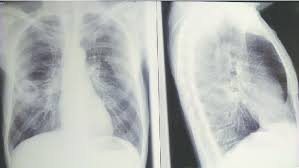 Image result for Lung Abscess