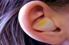 Ohrensausen 11 Hausmittel Gegen Tinnitus Ohrenschmerzen Ohrenschmerzen Hausmittel Zwiebel In Socke
