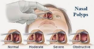It doesn't hurt to the touch, its smooth, looks like a grape, its a polyp. Natural Fitness Tips Natural Home Remedies For Nasal Polyps Sinus Remedies Allergy Remedies Sinusitis