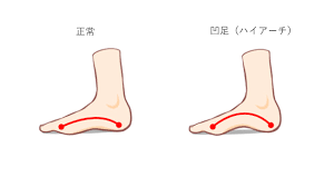 ハイアーチ 足 底 筋 膜 炎