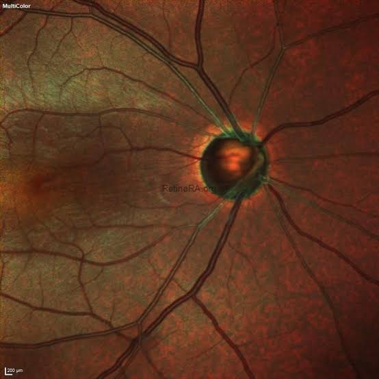 Acquired Optic Disc Pit Secondary to Glaucoma - RetinaRA