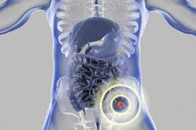 You're more likely to develop colon cancer if you have a blood relative who has had the disease. Treatment For Liver Metastasis From Colorectal Cancer
