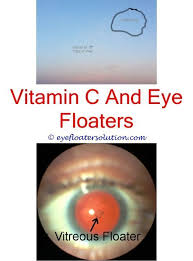 Large White Floater In Cat Eye Natural Things To Help Eye Floaters Eye Surgery To Remove Floater What Causes Eye Floaters Eye Floaters Treatment Floaters Eye
