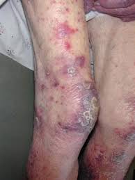 Image result for Leukemia