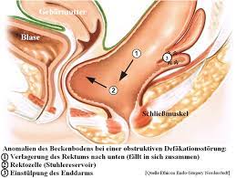 Proctology De End Und Dickdarmzentrum Duisburg Kompetenzzentrum Fur Koloproktologie Dr S Athanasiadis Dr P Meier Zu Eissen