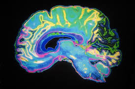 Determinación de muerte cerebral y muerte por criterios. Explicar Los Conflictos Eticos Rel