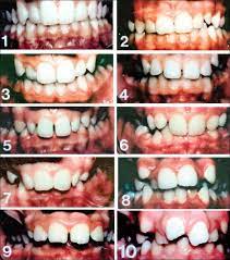 Ilustrasi menyikat gigi untuk menjaga kesehatan gigi. Tempoh Pemakaian Braces Ini Yang Patut Anda Tahu