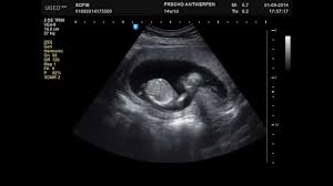14 Weeks Pregnant 2d Ultrasound Active Baby 14 Weeks Pregnant 15 Weeks Pregnant Pregnant