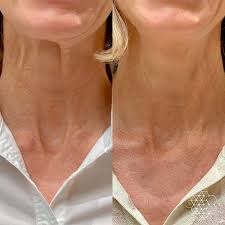 Neck Lines And Laxity Skin Technique