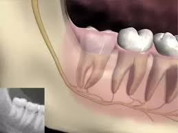 You want to use a lot of vitamin c to help your bones and gums to get healthy and grow better.and you wand. How To Make Your Wisdom Teeth Grow Faster Quora
