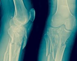 Knochenbruche Am Knie Pd Dr Med Sandro Kohl Kniechirurg Zurich