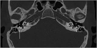Image result for Myringosclerosis