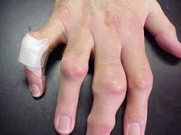 We did not find results for: Gout Gouty Arthritis Risk Factors Diagnosis And Treatment