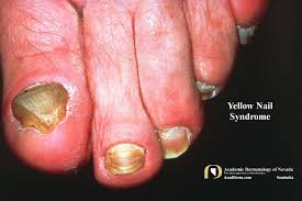 Image result for Yellow nail syndrome feet