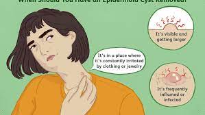 Home remedies to remove / get rid of of cyst at home. How To Spot And Treat Epidermoid Cysts