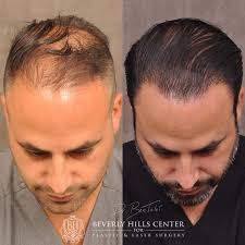 Hair transplants procedure involve transferring hair from an area unaffected by hair loss the same mistake as rooney: Hair Transplant Hairline Lowering Before Afters Beverly Hills Center