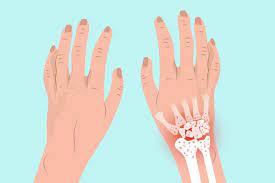 There are quite a few wrist conditions (strains, sprains, tendonitis, bursitis, tfcc tears, stress fractures) that can be improved with proper wrist conditioning. Arthritis In The Wrist Symptoms Types Of Wrist Arthritis Treatments