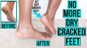 We may earn commission from the links on this page. How To Get Rid Of Dry Cracked Feet Fast Naturally At Home Remedies More Youtube