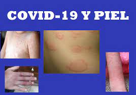 Covid 19 En Forma De Ronchas Y Sabanones Familia Y Salud