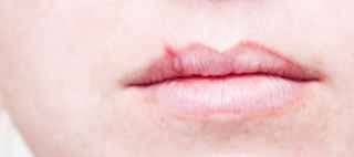 When is a cold sore no longer contagious. Are Cold Sores Contagious