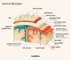 Meningitis: Symptoms, Causes, Types, Treatment, Risks, Vaccine