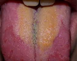 Image result for black hairy tongue symptoms
