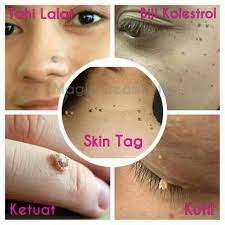 Cara penggunaan aplikasi ini juga sangat mudah anda cukup install dan seluruh iklan menggangu akan sirna. Cara Hilangkan Ketuat Kutil Biji Kolestrol Facebook