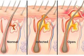 These ingredients help in soothing the area as well as lighten the scars. Treatments For Acne Scars On Buttocks