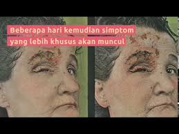 Betul ke kayap ular boleh membawa maut penyakit kayap penyebab simptom komplikasi dan rawatan. Penyakit Herpes Zoster Penyebab Gejala Dan Rawatan Doctoroncall