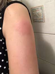 Whooping Cough Vaccine Swollen Red Lump February 2021 Birth Club Babycenter Australia