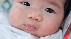 Kanker kelenjar air liur adalah tumor ganas yang bermula pada salah satu kelenjar ludah. Bawah Setahun Bayi Meleleh Air Liur Normal Lepas Setahun Masih Sama Kena Check Pa Ma