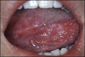 Image result for lichen planus on tongue)