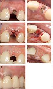 When your teeth are extracted from the jaws. Pdf Histologic Analysis Of Healing After Tooth Extraction With Ridge Preservation Using Mineralized Human Bone Allograft Semantic Scholar