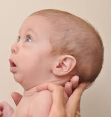 Pierre Robin Sequence Prs Hellenic Craniofacial Center