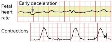 Image result for Early Deceleration