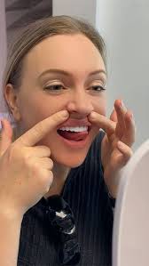 Another masterpiece! Previously our patient’s teeth were a distraction that  she felt they were holding her back from feeling her best. She disliked how  she was missing a lateral tooth, her teeth were ...