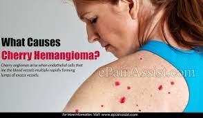 Unfortunately, there is not enough data to determine the actual causes of cherry angioma. What Causes Cherry Hemangioma