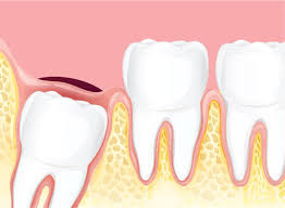 We did not find results for: What Is A Wisdom Tooth Symptoms Treatment When They Come In