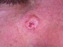 In the united states, it's estimated that doctors diagnose over 100,000 new skin cancer cases each year. Types Of Skin Cancer Peninsula Dermatology