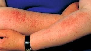 There are chemicals and fragrances and preservatives. Sun Rash Poisoning Allergy Treatment Causes Pictures And More