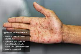 Welche Symptome Treten Bei Syphilis Auf