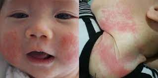 Ruam panas, umumnya dikenal sebagai biang keringat, adalah ruam kulit yang disebabkan karena kulit ada sejumlah cara yang dapat secara efektif mengobati dan menyembuhkan semua gejala. Petua Hilangkan Ruam Bayi 25 Tips Elak Ruam Susu Pada Si Manja Theasianparent Malaysia