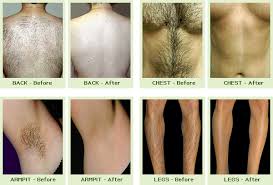 Learn about waxing, laser, electrolysis unless of course, you're a man, in which case you should check out our article on hair removal. How Does Laser Hair Removal Function Health Articles News