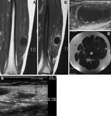 Treatment of hepatic hydatid is based on ultrasound staging and considerations of the size, location and manifestations of cysts, and the overall health thus we conclude that percutaneous treatment is a safe and effective alternative therapy in treating gharbi type iii hepatic hydatid cysts for patients. Diagnosis And Percutaneous Treatment Of Soft Tissue Hydatid Cysts Springerlink
