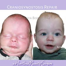September is craniosynostosis awareness month. 💜 Bentley has Sagittal who  was 1 year old when he went undergo a 8 hr surgery last year in September  and turns 2 in September 🫶🏻